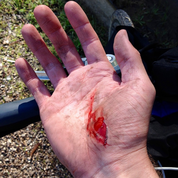 Dan's right hand with a fairly large patch of skin missing.